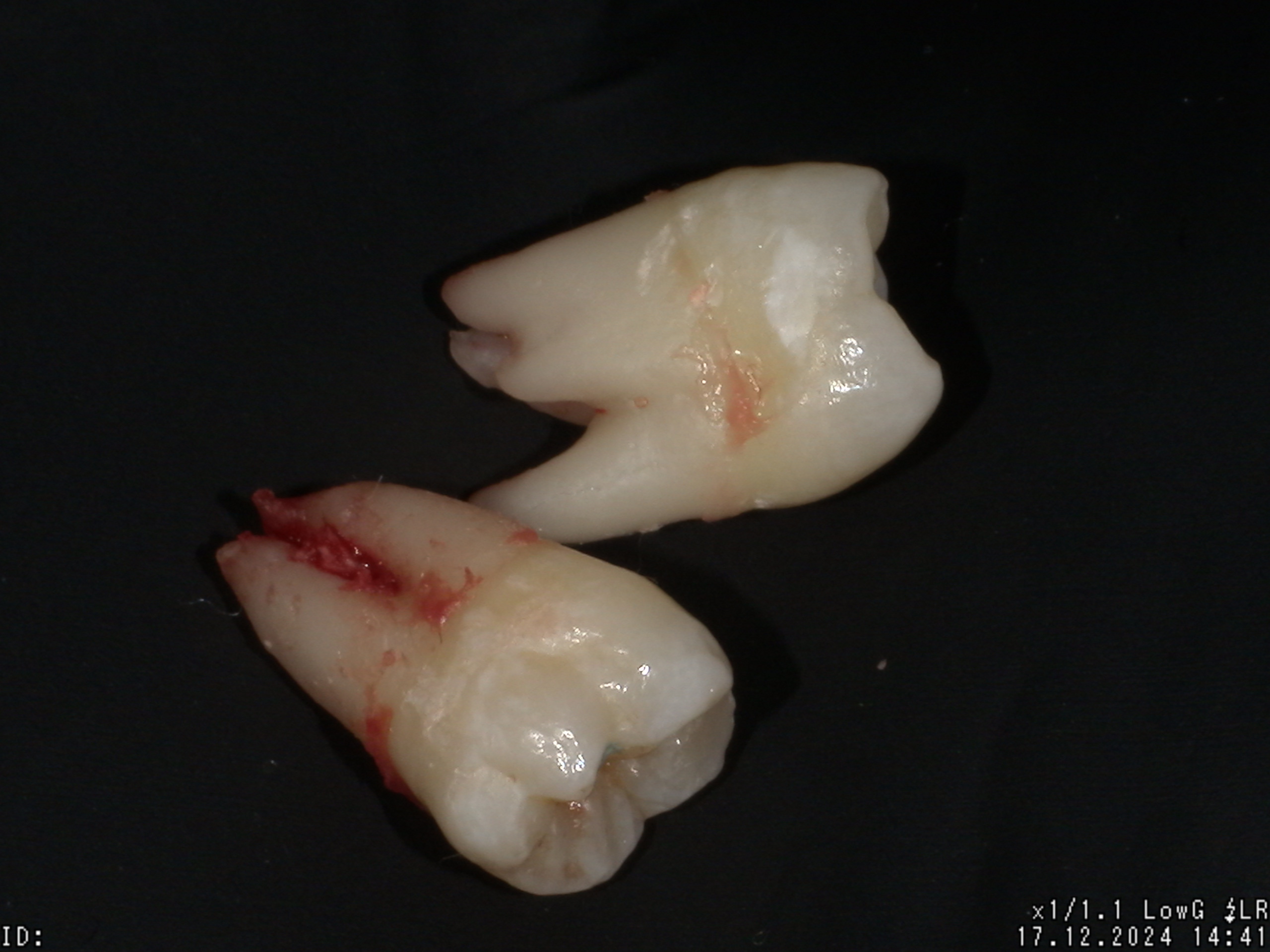 Oral Surgery & Wisdom Teeth Removal at Hamilton Care Dental Centre in Hamilton
