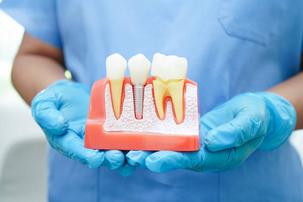 Dental Implants at Hamilton Care Dental Centre in Hamilton