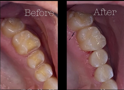 Restorative Dentistry at Hamilton Care Dental Centre in Hamilton