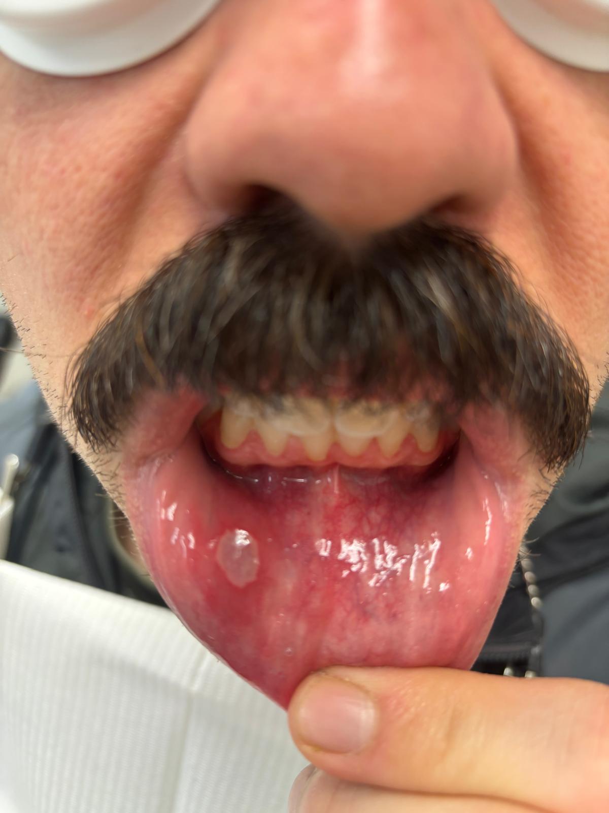 Canker sore treatment at Hamilton Care Dental Centre, view two