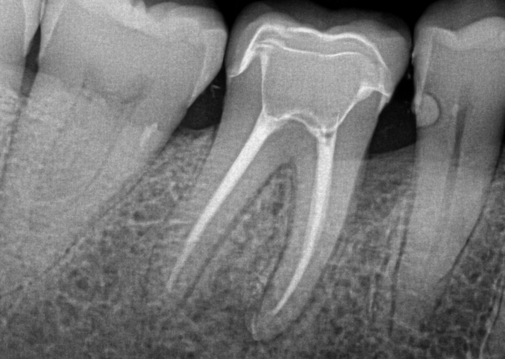 Endodontics (Root Canals) at Hamilton Care Dental Centre in Hamilton
